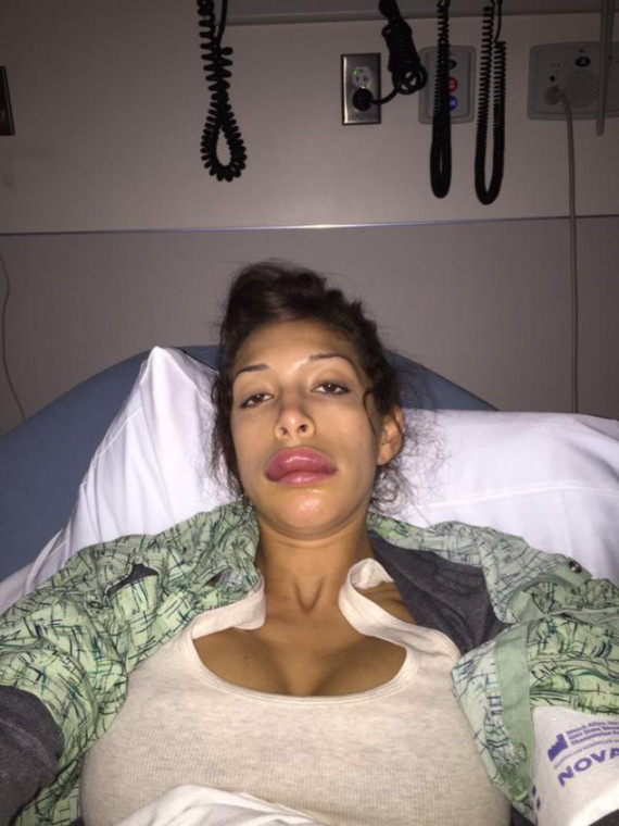 Farrah Abraham lip surgery fail